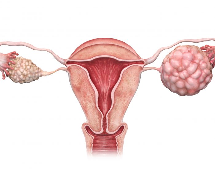 Ovarian cancer: symptoms, diagnosis, treatment
