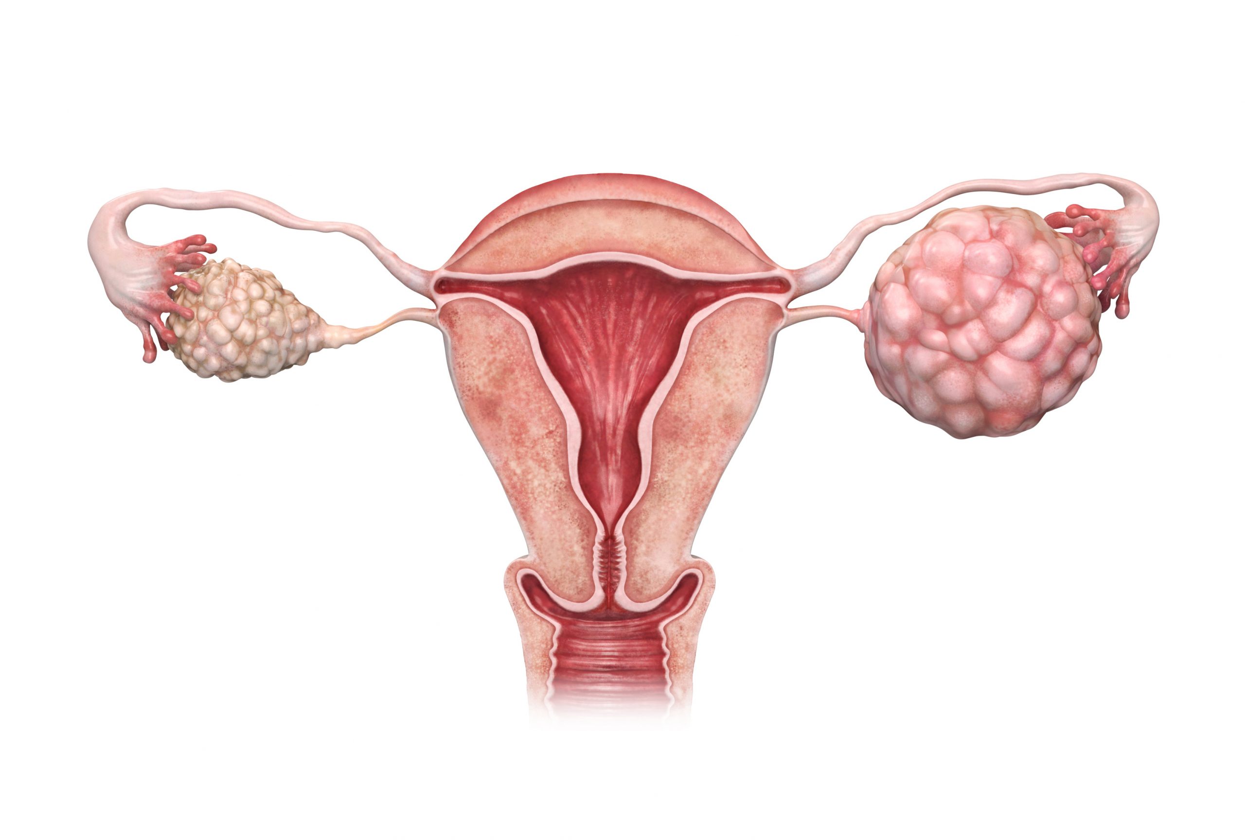Ovarian cancer: symptoms, diagnosis, treatment
