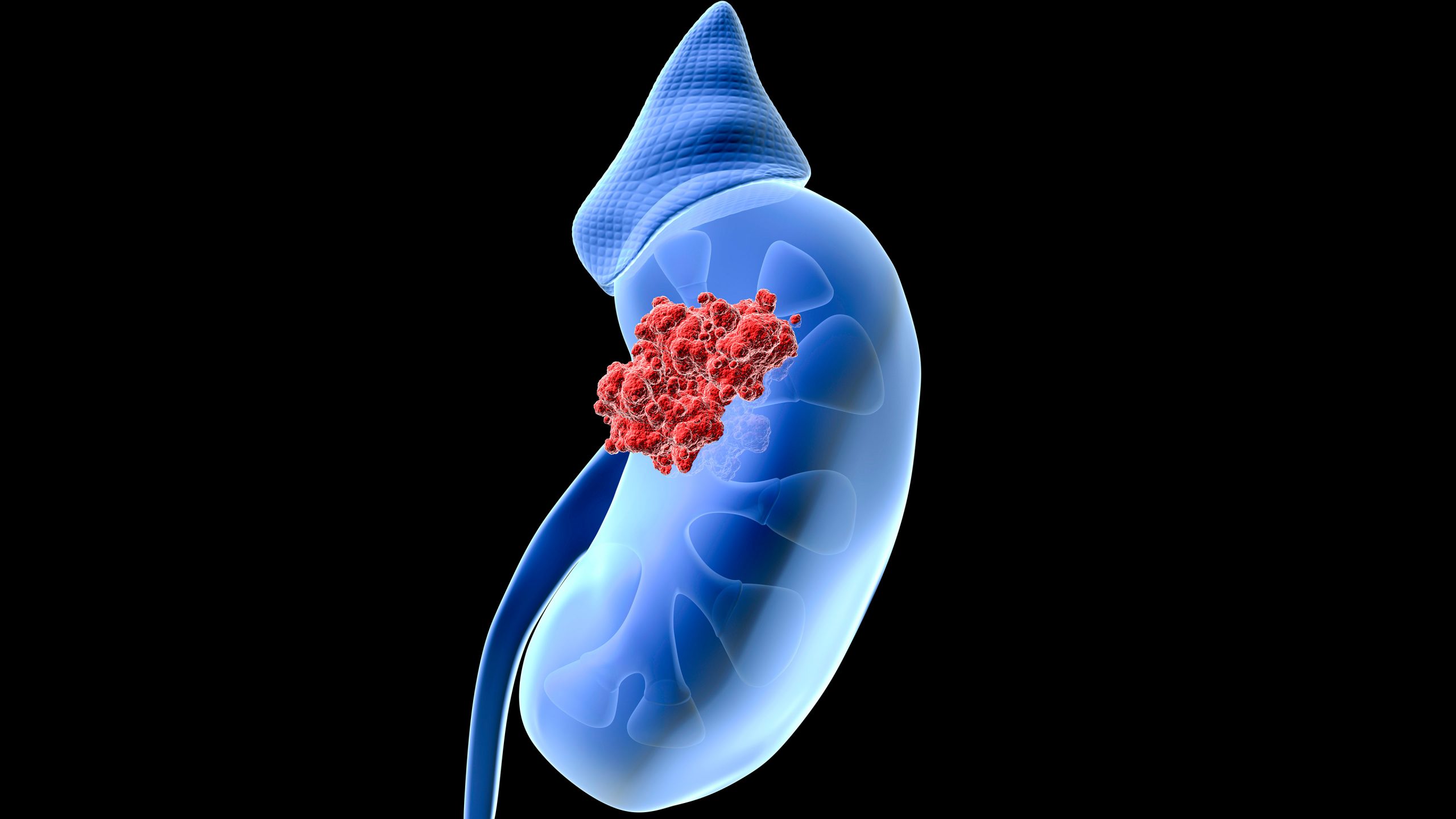 Kidney cancer: symptoms, types, diagnosis and treatment