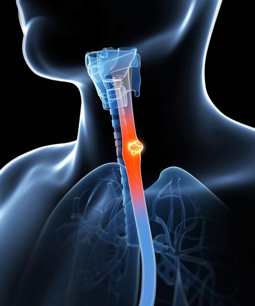 Larynx cancer: symptoms and signs, stages, diagnosis and treatment features