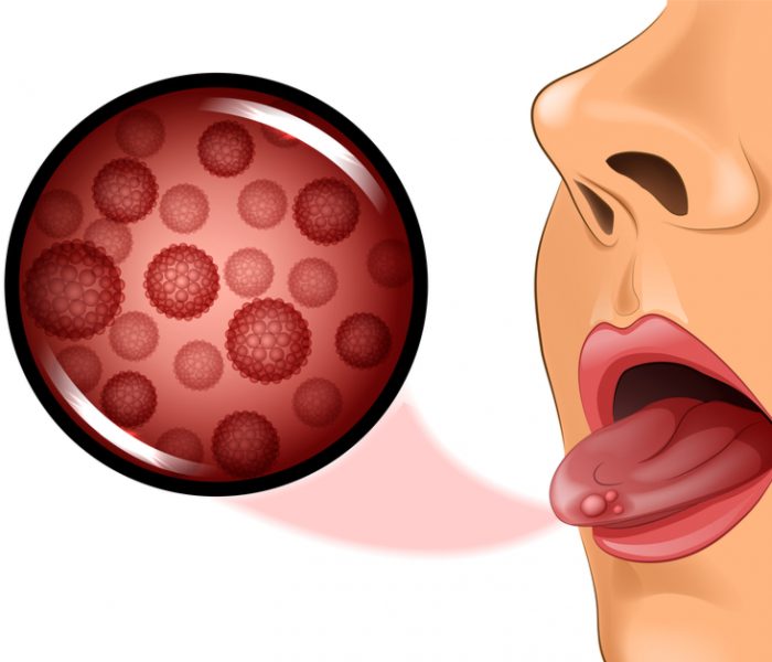 What is tongue cancer and how is it dangerous?