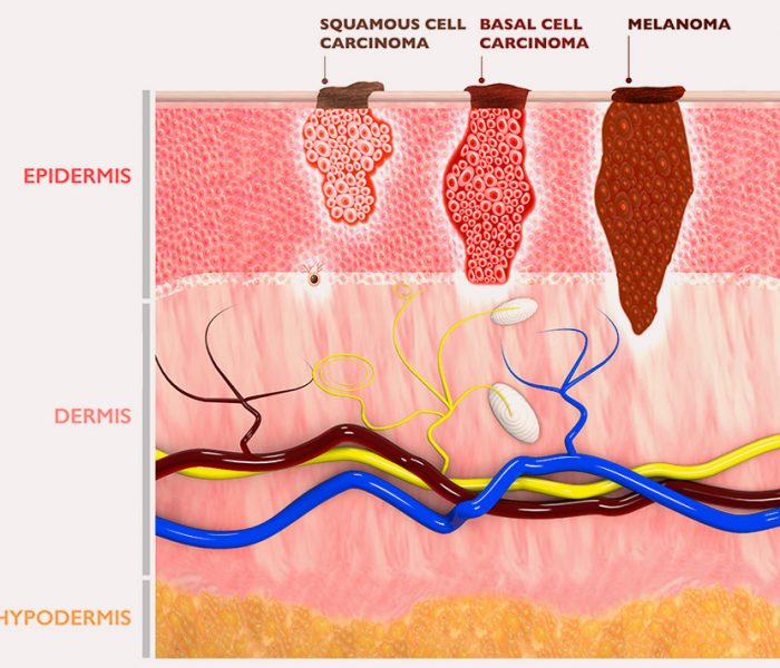 Early signs of melanoma