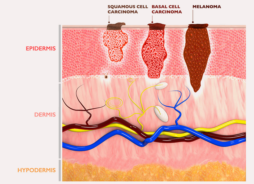 Early signs of melanoma